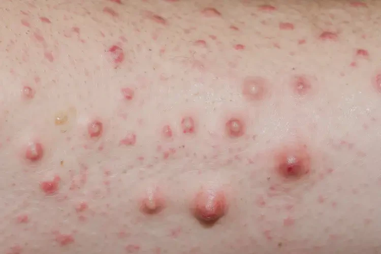 女人身上出现湿疹能够彻底治愈吗(图4)