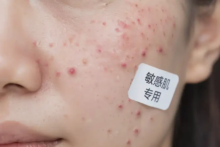 男生脸上经常起湿疹可不可以根治(图4)