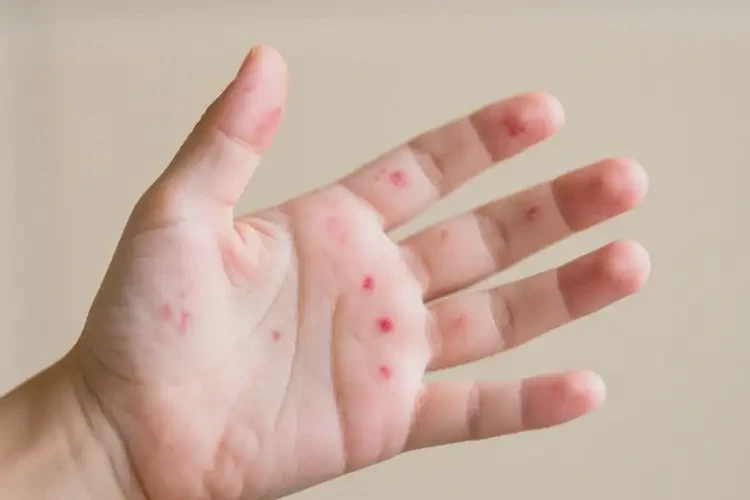 少兒手上長濕疹可以治好嗎(圖4)