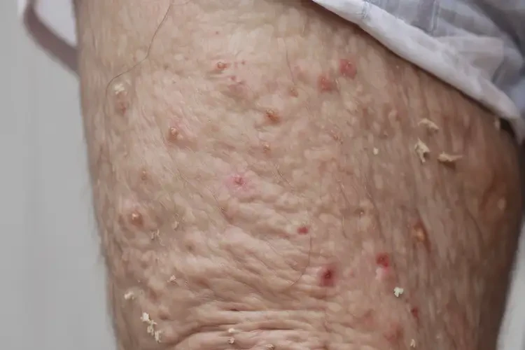 高齡老人大腿上容易起濕疹可不可以根治(圖4)