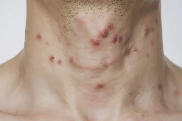 青年人脖子上長(zhǎng)濕疹能夠徹底治愈嗎(圖4)