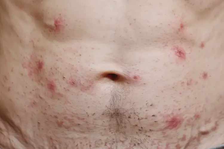 老年人肚子出湿疹可不可以根治(图4)