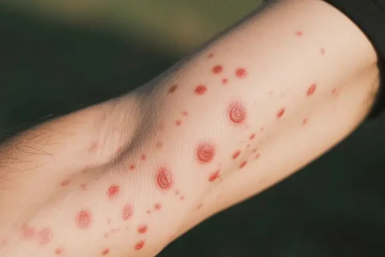 男性手臂上經(jīng)常起濕疹可以治好嗎(圖4)