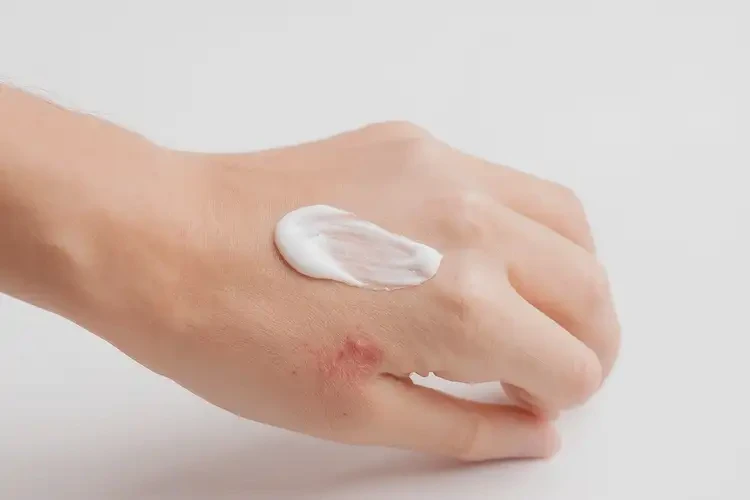 青少年手上經(jīng)常起濕疹可不可以根治(圖3)