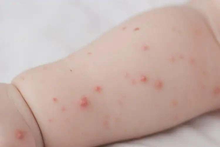 孩子屁股上出現(xiàn)濕疹不管它會自己自愈嗎(圖4)