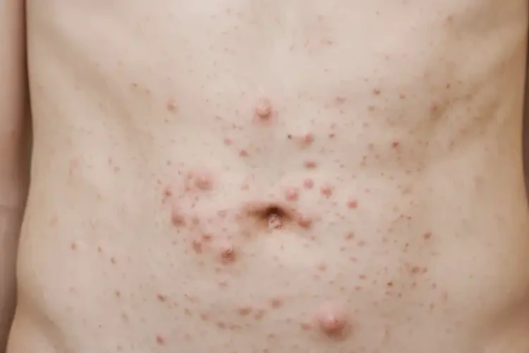 青少年肚子起濕疹可不可以根治(圖4)