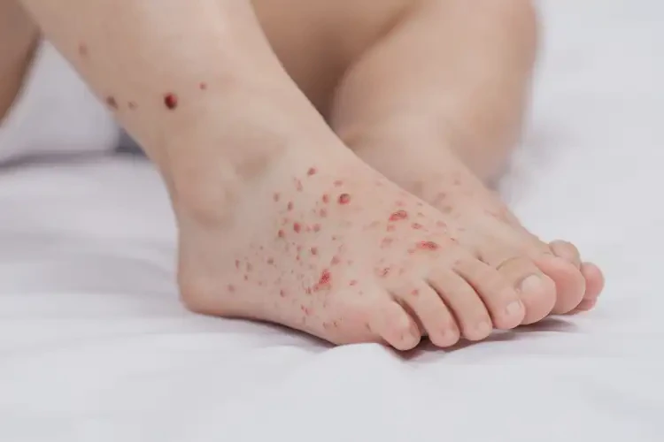 小兒腳上經(jīng)常長(zhǎng)濕疹可不可以根治(圖4)