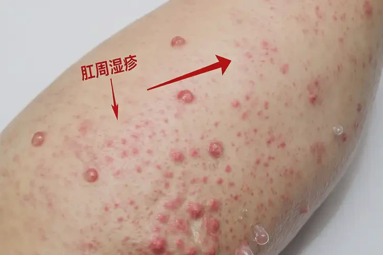 男生肛周经常长湿疹可不可以根治(图4)