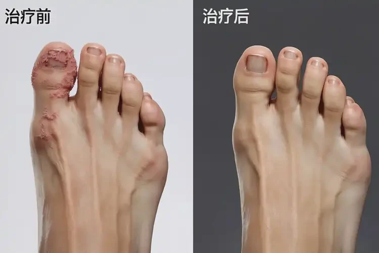 產(chǎn)婦腳上偶爾起濕疹可不可以根治(圖1)