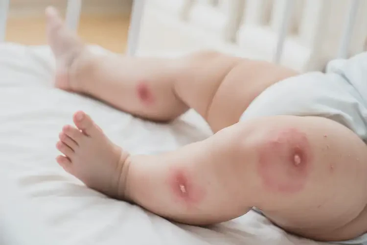 嬰幼兒小腿偶爾起濕疹能徹底自愈嗎(圖3)