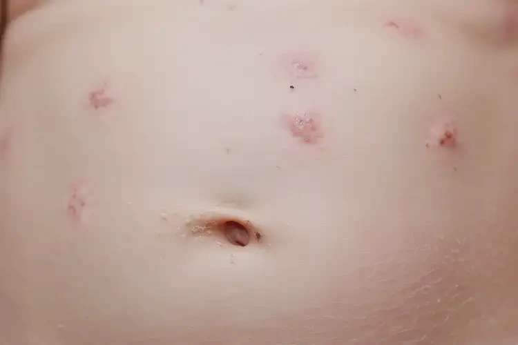 新生兒肚子長(zhǎng)濕疹不管它會(huì)自己痊愈嗎(圖4)