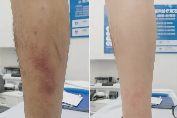 老年人小腿偶爾長濕疹可以徹底自愈嗎(圖1)