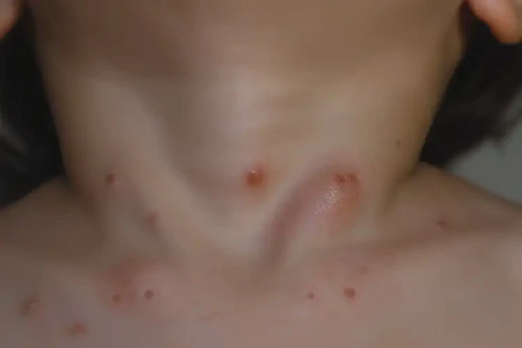 兒童脖子上偶爾起濕疹可不可以根治(圖4)