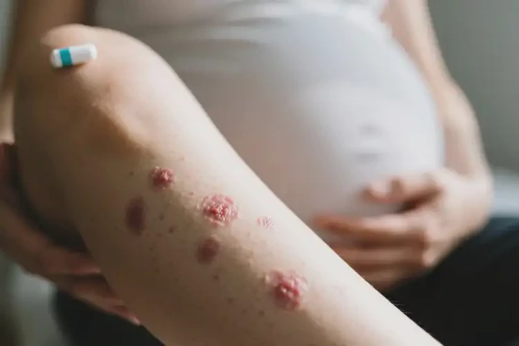 孕婦小腿出現(xiàn)濕疹可不可以根治(圖2)