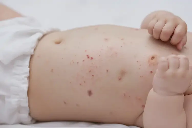 嬰幼兒肚子出濕疹能靠自己自愈嗎(圖4)