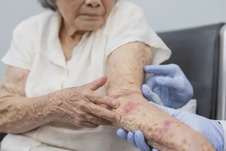 老年人四肢容易長濕疹可不可以根治(圖3)