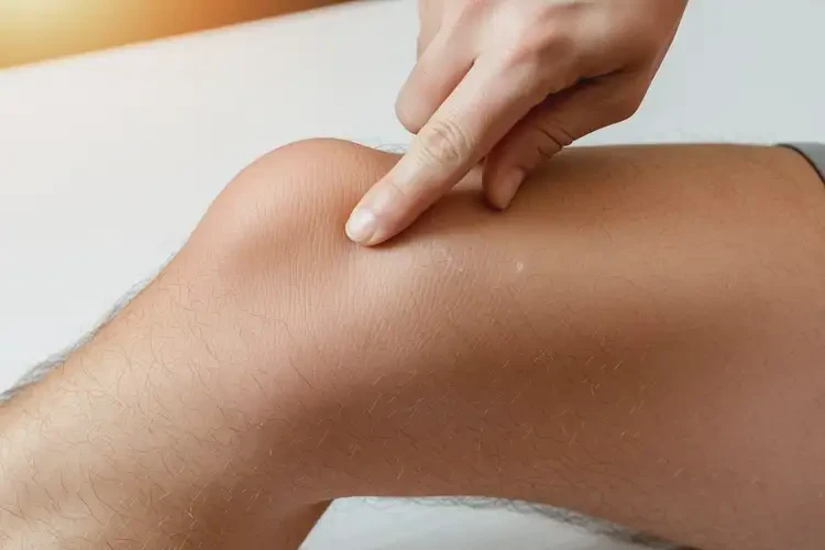 男性大腿有濕疹可不可以根治(圖2)