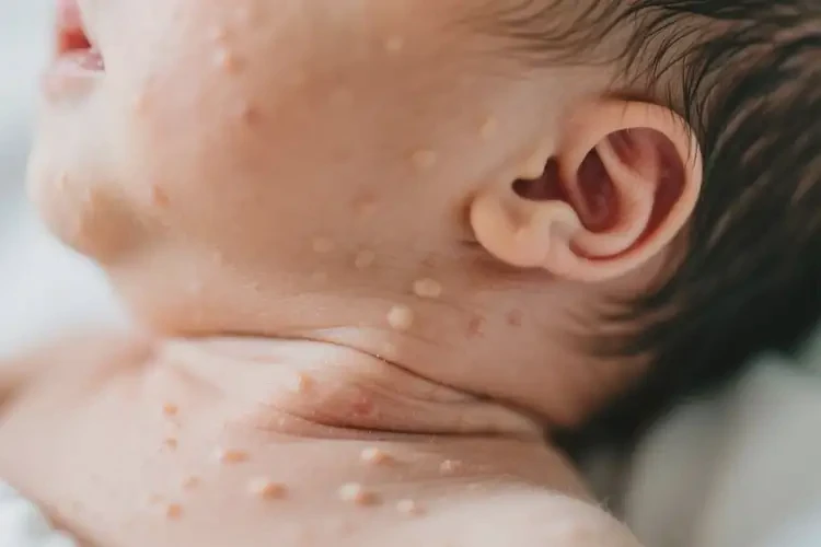 新生兒脖子上經(jīng)常起濕疹可不可以根治(圖1)