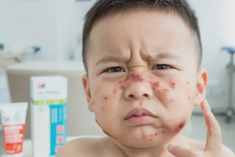 少兒全身經(jīng)常起濕疹不管它會自己痊愈嗎(圖4)
