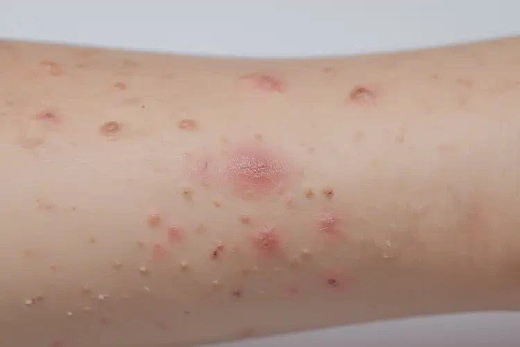 小孩全身偶尔长湿疹可以治好吗(图4)