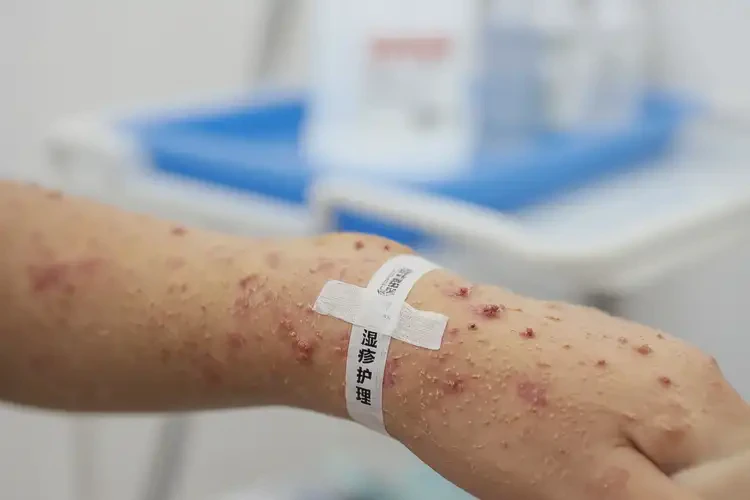 兒童手臂長(zhǎng)濕疹能夠徹底治愈嗎(圖4)