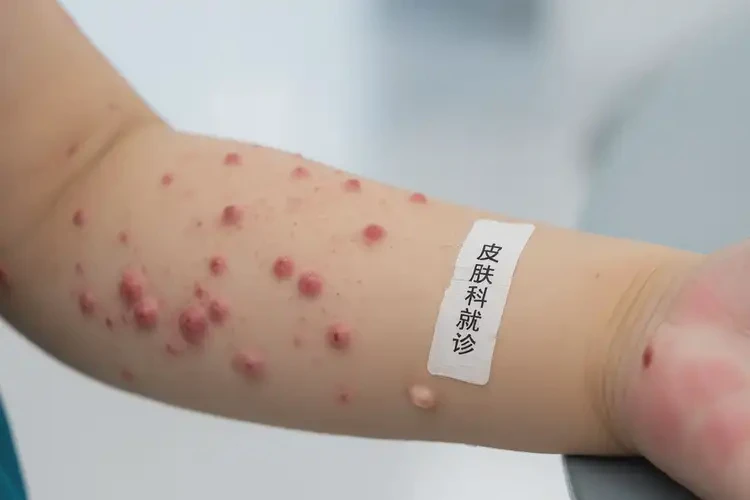 孩子手臂經(jīng)常起濕疹可以治好嗎(圖4)