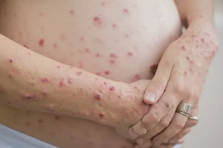 孕妇手臂经常起湿疹可不可以根治(图4)