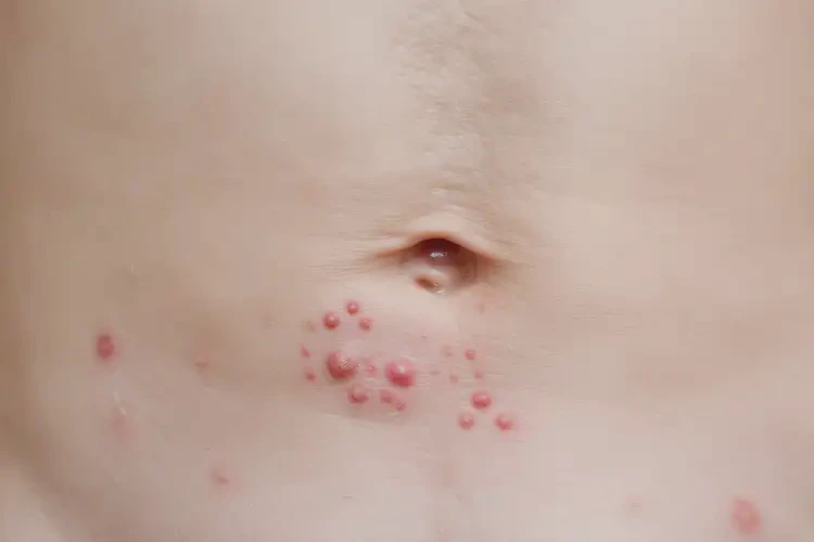 小孩肛周偶尔起湿疹可以治好吗(图4)