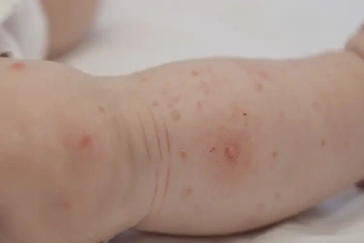 寶寶小腿上長濕疹可以治好嗎(圖4)