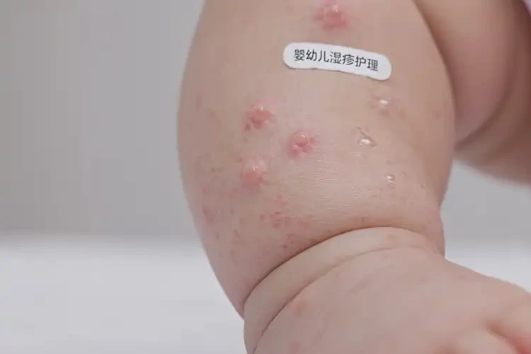 婴幼儿四肢容易长湿疹可不可以根治(图4)