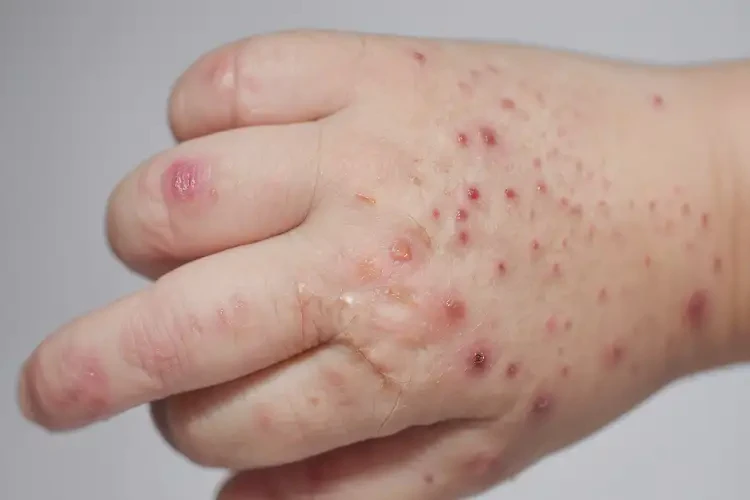 少兒手上容易長濕疹可不可以根治(圖4)