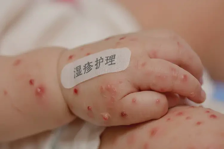 嬰兒手上起濕疹可以治好嗎(圖4)