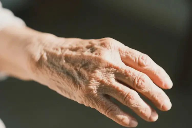 老人手臂上出現(xiàn)濕疹可以治好嗎(圖3)