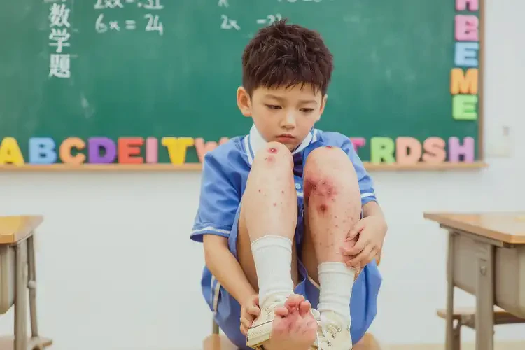 小學(xué)生腳上有濕疹可不可以根治(圖2)