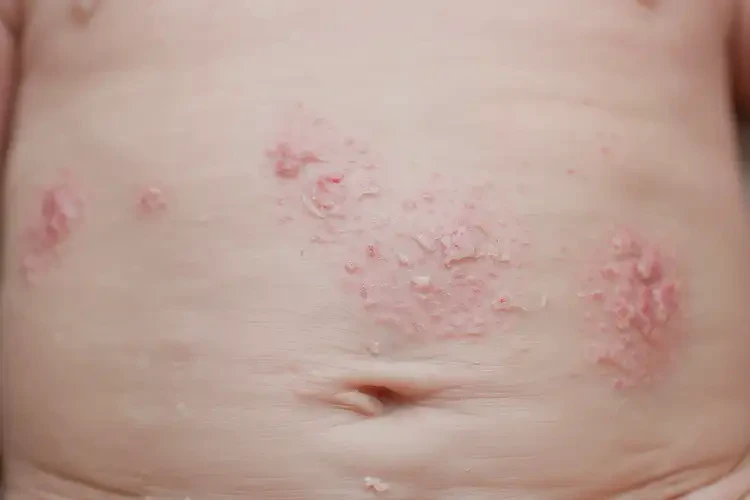 新生兒肚子偶爾起濕疹可不可以根治(圖4)