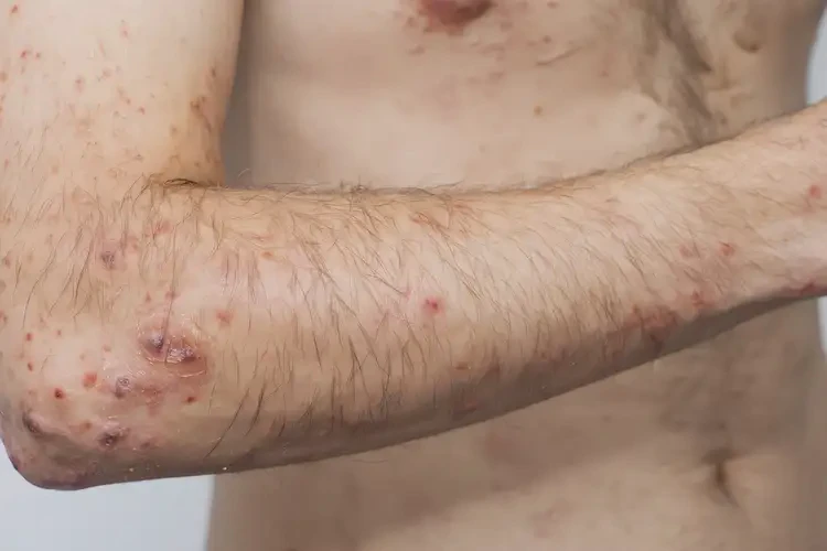 男生四肢長(zhǎng)濕疹可不可以根治(圖4)