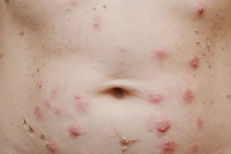 女性肚子上偶爾起濕疹可不可以根治(圖4)