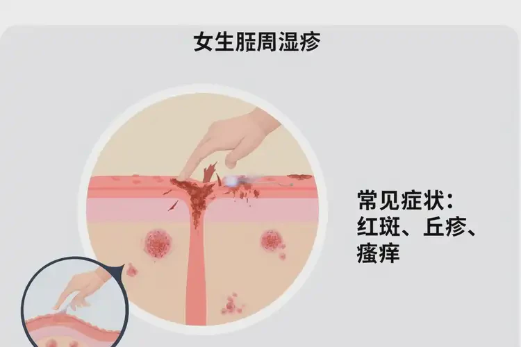 女性肛周偶尔起湿疹可不可以根治(图4)