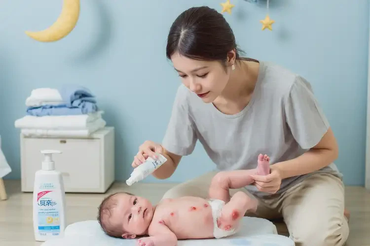 孩子屁股長(zhǎng)濕疹可以治好嗎(圖3)