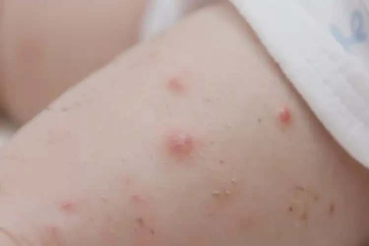 宝宝屁股容易长湿疹不管它会自己痊愈吗(图4)