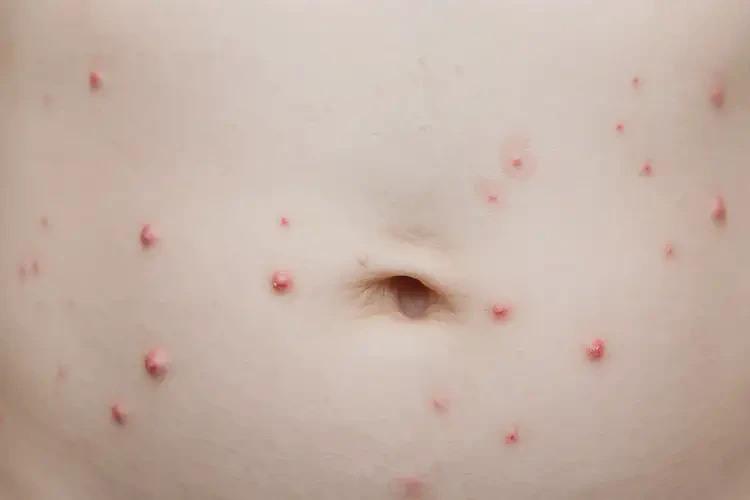 小孩肚子容易長濕疹可以治好嗎(圖3)