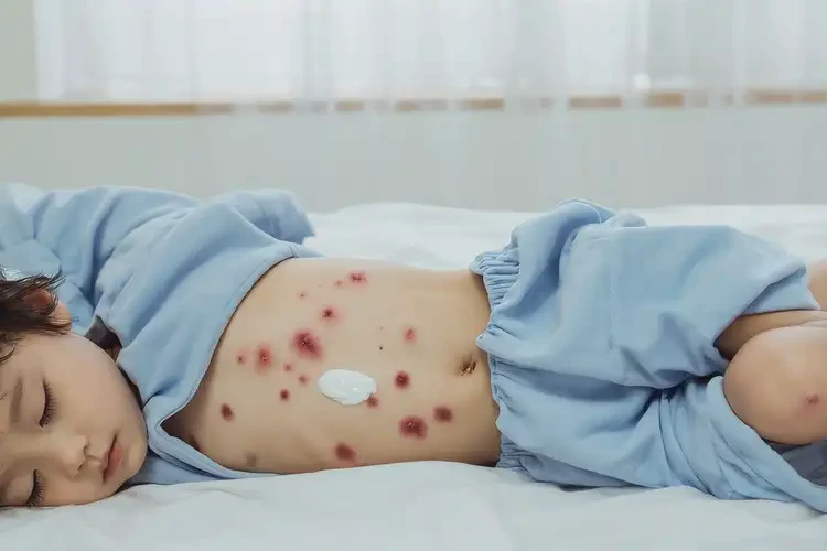 少兒肚子有濕疹可不可以根治(圖2)