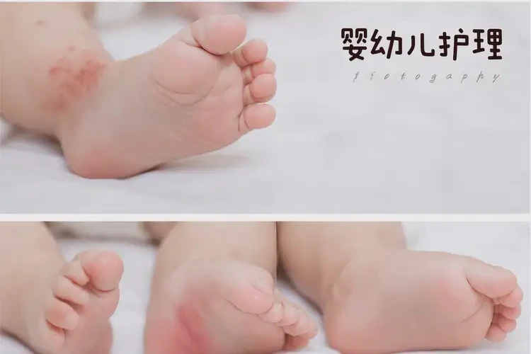 寶寶腳上容易起濕疹可以徹底自愈嗎(圖3)