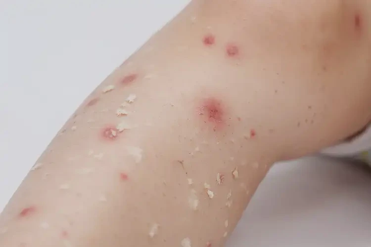 小兒大腿長濕疹可不可以根治(圖4)