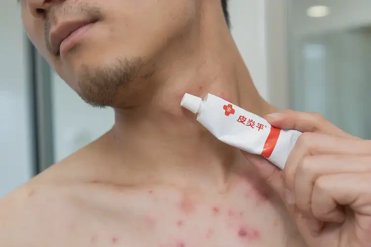 青年人脖子起濕疹可不可以根治(圖4)