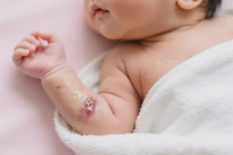 新生兒手臂上有濕疹可不可以根治(圖1)
