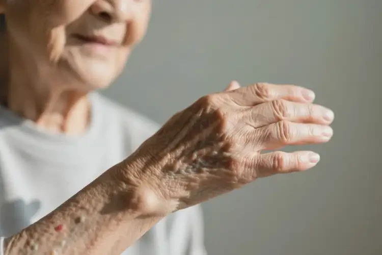 老人手臂上出現(xiàn)濕疹可以治好嗎(圖2)