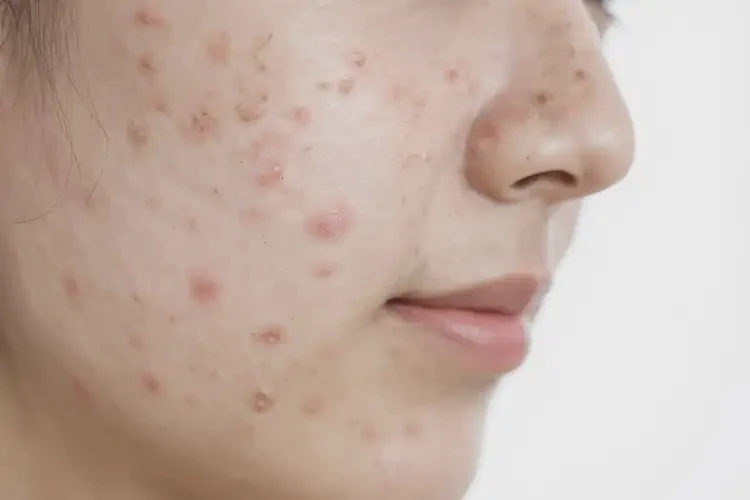 女性屁股上出濕疹不管它會自己好嗎(圖4)