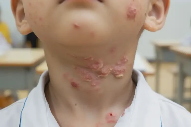 小學生脖子出現(xiàn)濕疹可不可以根治(圖4)