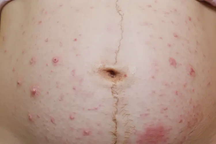 產(chǎn)婦肚子上偶爾長濕疹可以治好嗎(圖4)